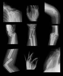 Bone-Trauma-Understanding-Types-and-Treatment